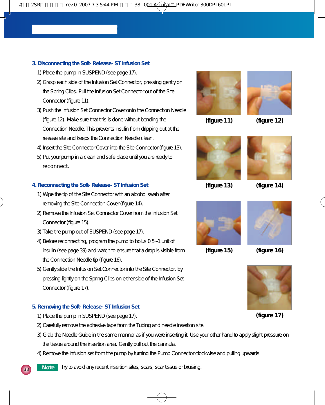 3 83. Disconnecting the Soft-Release-ST Infusion Set1) Place the pump in SUSPEND (see page 17).2) Grasp each side of the Infusion Set Connector, pressing gently onthe Spring Clips. Pull the Infusion Set Connector out of the SiteConnector (figure 11).3) Push the Infusion Set Connector Cover onto the Connection Needle(figure 12). Make sure that this is done without bending theConnection Needle. This prevents insulin from dripping out at therelease site and keeps the Connection Needle clean. 4) Insert the Site Connector Cover into the Site Connector (figure 13).5) Put your pump in a clean and safe place until you are ready tor e c o n n e c t .4. Reconnecting the Soft-Release-ST Infusion Set1) Wipe the tip of the Site Connector with an alcohol swab afterremoving the Site Connection Cover (figure 14).2) Remove the Infusion Set Connector Cover from the Infusion SetConnector (figure 15).3) Take the pump out of SUSPEND (see page 17).4) Before reconnecting, program the pump to bolus 0.5~1 unit ofinsulin (see page 39) and watch to ensure that a drop is visible fromthe Connection Needle tip (figure 16).5) Gently slide the Infusion Set Connector into the Site Connector, bypressing lightly on the Spring Clips on either side of the Infusion SetConnector (figure 17).5. Removing the Soft-Release-ST Infusion Set1) Place the pump in SUSPEND (see page 17). 2) Carefully remove the adhesive tape from the Tubing and needle insertion site.3) Grab the Needle Guide in the same manner as if you were inserting it. Use your other hand to apply slight pressure onthe tissue around the insertion area. Gently pull out the cannula.4) Remove the infusion set from the pump by turning the Pump Connector clockwise and pulling upwards.(figure 11) (figure 12)(figure 13) (figure 14)(figure 15) (figure 16)(figure 17)N o t e Try to avoid any recent insertion sites, scars, scar tissue or bruising.#다나2SR영문메뉴얼 rev.0  2007.7.3 5:44 PM  페이지38   001 Acrobat™ PDFWriter 300DPI 60LPI