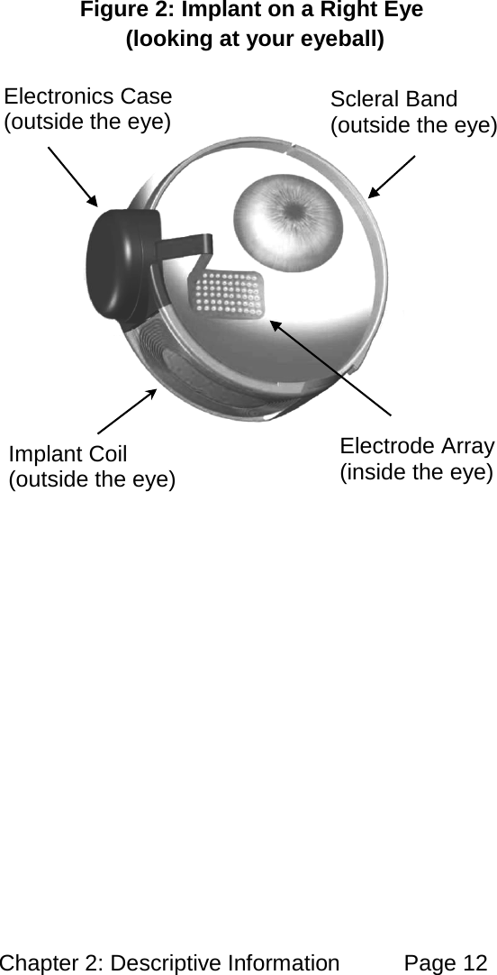Chapter 2: Descriptive Information Page 12 Figure 2: Implant on a Right Eye (looking at your eyeball) Electronics Case (outside the eye) Implant Coil (outside the eye) Scleral Band (outside the eye) Electrode Array (inside the eye)