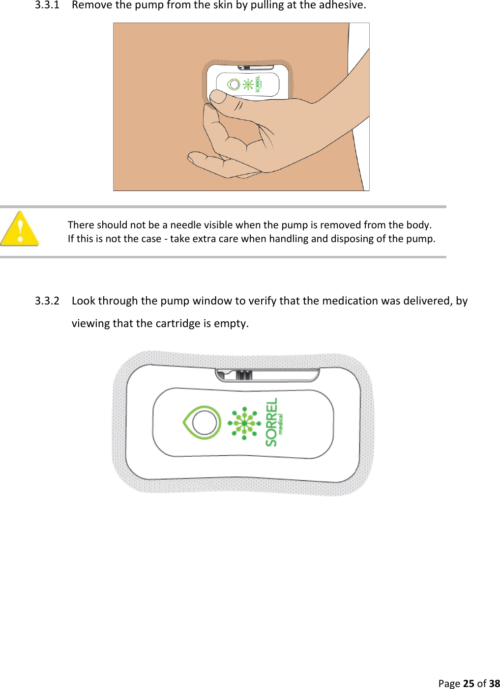  Page 25 of 38  3.3.1 Remove the pump from the skin by pulling at the adhesive.     There should not be a needle visible when the pump is removed from the body. If this is not the case - take extra care when handling and disposing of the pump.    3.3.2 Look through the pump window to verify that the medication was delivered, by viewing that the cartridge is empty.    