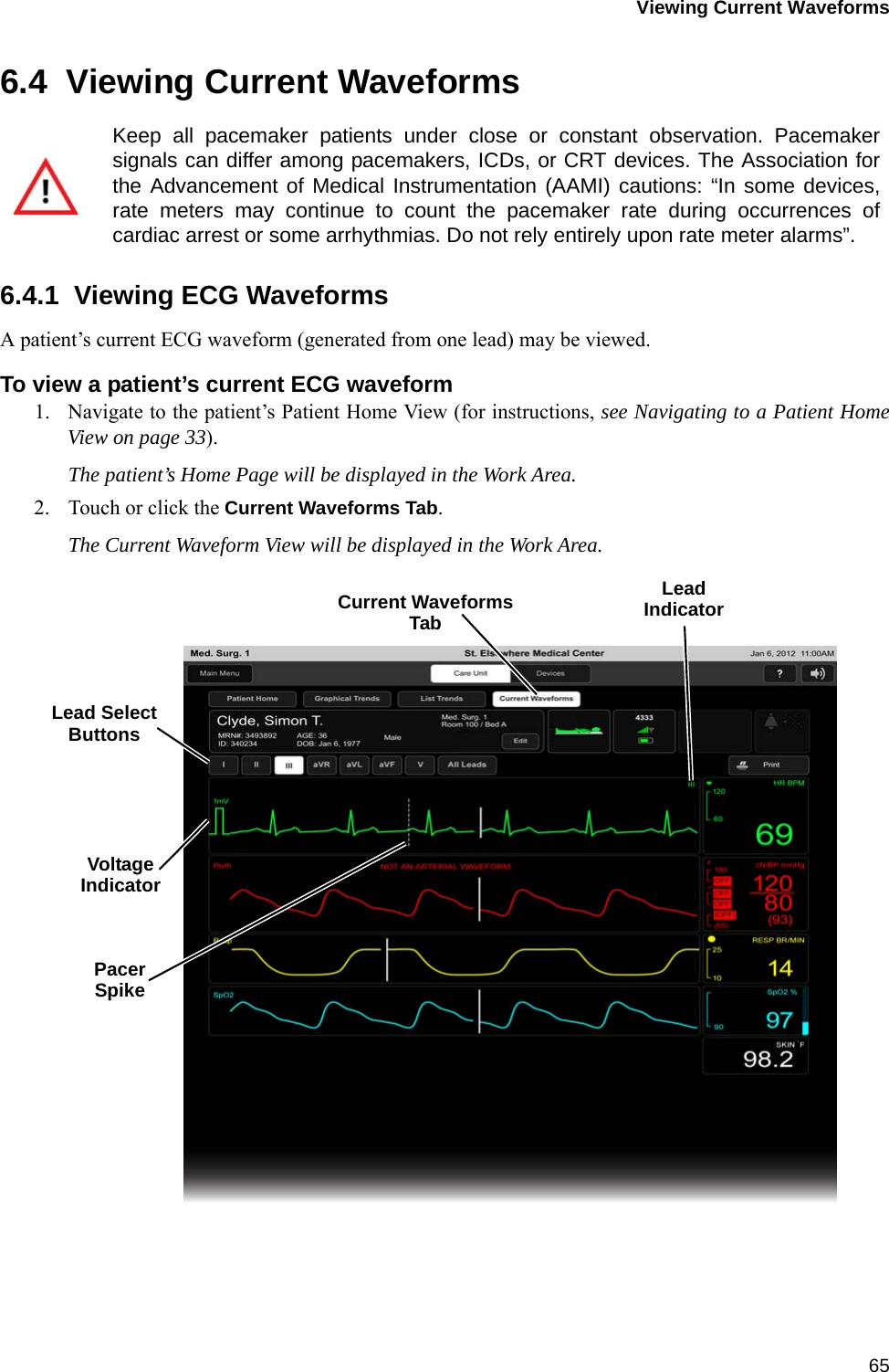 Viewing Current Waveforms656.4  Viewing Current Waveforms6.4.1  Viewing ECG WaveformsA patient’s current ECG waveform (generated from one lead) may be viewed.To view a patient’s current ECG waveform1. Navigate to the patient’s Patient Home View (for instructions, see Navigating to a Patient HomeView on page 33).The patient’s Home Page will be displayed in the Work Area.2. Touch or click the Current Waveforms Tab.The Current Waveform View will be displayed in the Work Area.Keep all pacemaker patients under close or constant observation. Pacemakersignals can differ among pacemakers, ICDs, or CRT devices. The Association forthe Advancement of Medical Instrumentation (AAMI) cautions: “In some devices,rate meters may continue to count the pacemaker rate during occurrences ofcardiac arrest or some arrhythmias. Do not rely entirely upon rate meter alarms”.LeadVoltageLead SelectCurrent WaveformsIndicatorButtonsIndicatorTabPacerSpike