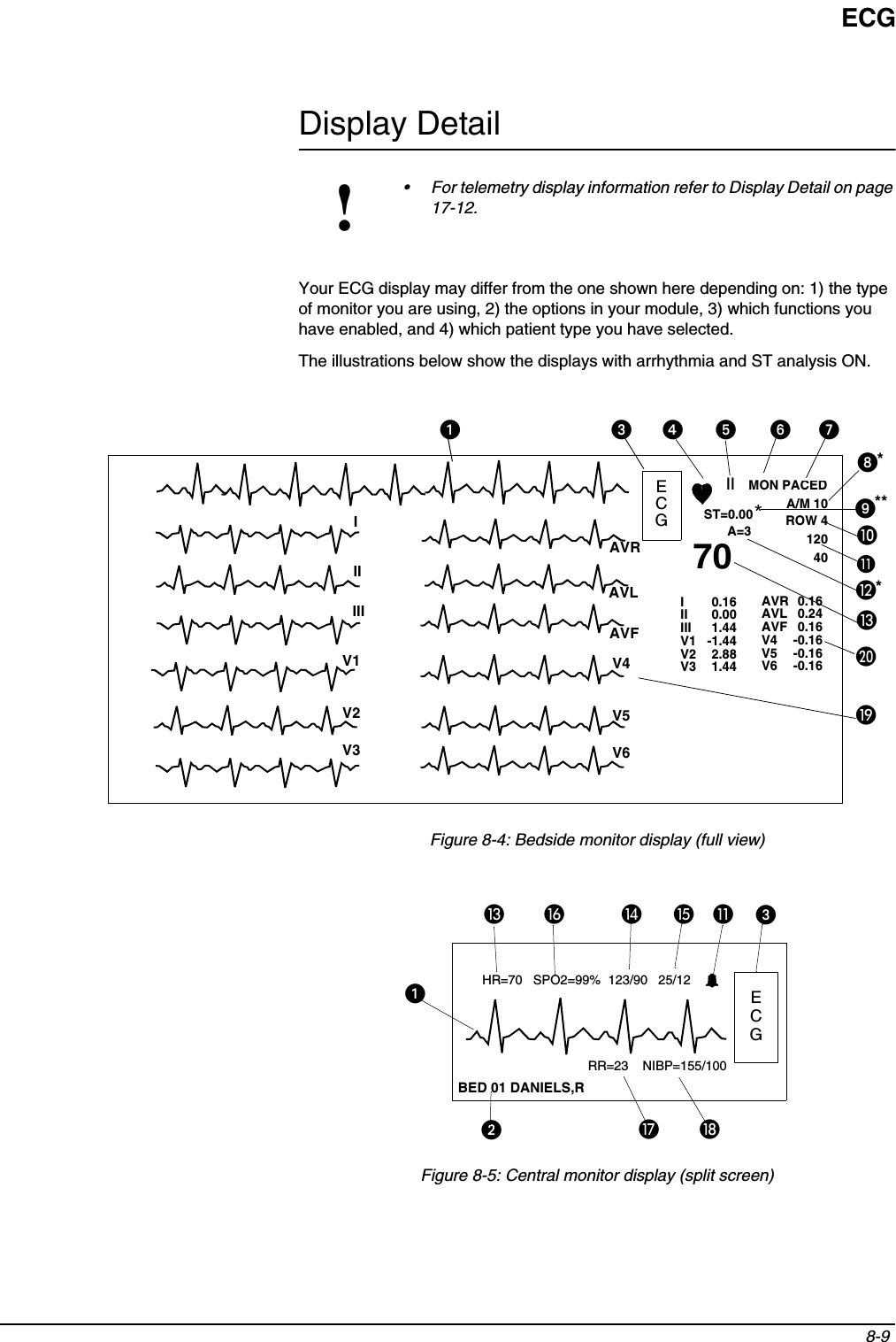 ECG8-9 Display DetailYour ECG display may differ from the one shown here depending on: 1) the type of monitor you are using, 2) the options in your module, 3) which functions you have enabled, and 4) which patient type you have selected.The illustrations below show the displays with arrhythmia and ST analysis ON.Figure 8-4: Bedside monitor display (full view)Figure 8-5: Central monitor display (split screen)!• For telemetry display information refer to Display Detail on page 17-12.**ECGIIA=3A/M 10ROW 41204070AVRAVLAVFV4V5V6V1V2V3IIIIIIIIIIIIV1V2V3AVRAVL  AVFV4V5V60.160.001.44 -1.442.881.440.160.16-0.16-0.16-0.160.24ST=0.00***MON PACED쐅쐉쐈씏씎씈ECGHR=70   SPO2=99%  123/90   25/12BED 01 DANIELS,RRR=23    NIBP=155/100씌씍쐈씊씉씋씈