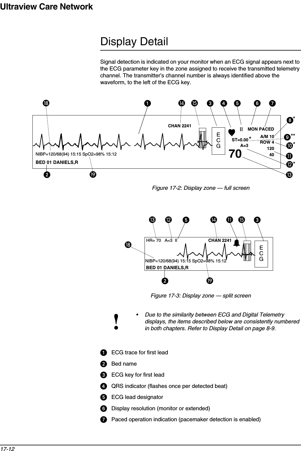 Ultraview Care Network17-12Display DetailSignal detection is indicated on your monitor when an ECG signal appears next to the ECG parameter key in the zone assigned to receive the transmitted telemetry channel. The transmitter’s channel number is always identified above the waveform, to the left of the ECG key.Figure 17-2: Display zone — full screenFigure 17-3: Display zone — split screenᕡECG trace for first leadᕢBed nameᕣECG key for first leadᕤQRS indicator (flashes once per detected beat)ᕥECG lead designatorᕦDisplay resolution (monitor or extended)ᕧPaced operation indication (pacemaker detection is enabled)!• Due to the similarity between ECG and Digital Telemetry displays, the items described below are consistently numbered in both chapters. Refer to Display Detail on page 8-9.ECGII MON PACEDST=0.00A=3A/M 10ROW 41204070*****BED 01 DANIELS,RᕢƽƸ¹¸ᕩµᕨ*ᕧᕦƾᕤᕣƺƹᕡNIBP=120/68(94) 15:15 SpO2=98% 15:12CHAN 2241ᕥECGHR= 70  A=3 IINIBP=120/68(94) 15:15 SpO2=98% 15:12CHAN 2241ᕣƺƹƸ ¹BED 01 DANIELS,Rᕢᕥƾƽ¸