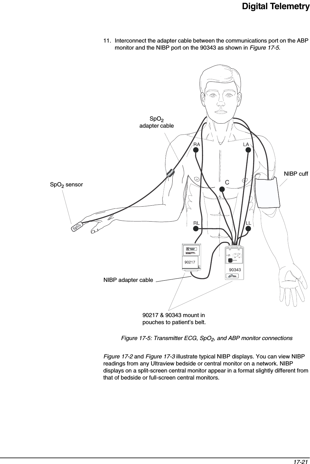 Digital Telemetry17-21 11. Interconnect the adapter cable between the communications port on the ABP monitor and the NIBP port on the 90343 as shown in Figure 17-5.Figure 17-5: Transmitter ECG, SpO2, and ABP monitor connectionsFigure 17-2 and Figure 17-3 illustrate typical NIBP displays. You can view NIBP readings from any Ultraview bedside or central monitor on a network. NIBP displays on a split-screen central monitor appear in a format slightly different from that of bedside or full-screen central monitors.SpO2 sensorNIBP adapter cableNIBP cuffSpO2adapter cable90217 &amp; 90343 mount in pouches to patient’s belt.