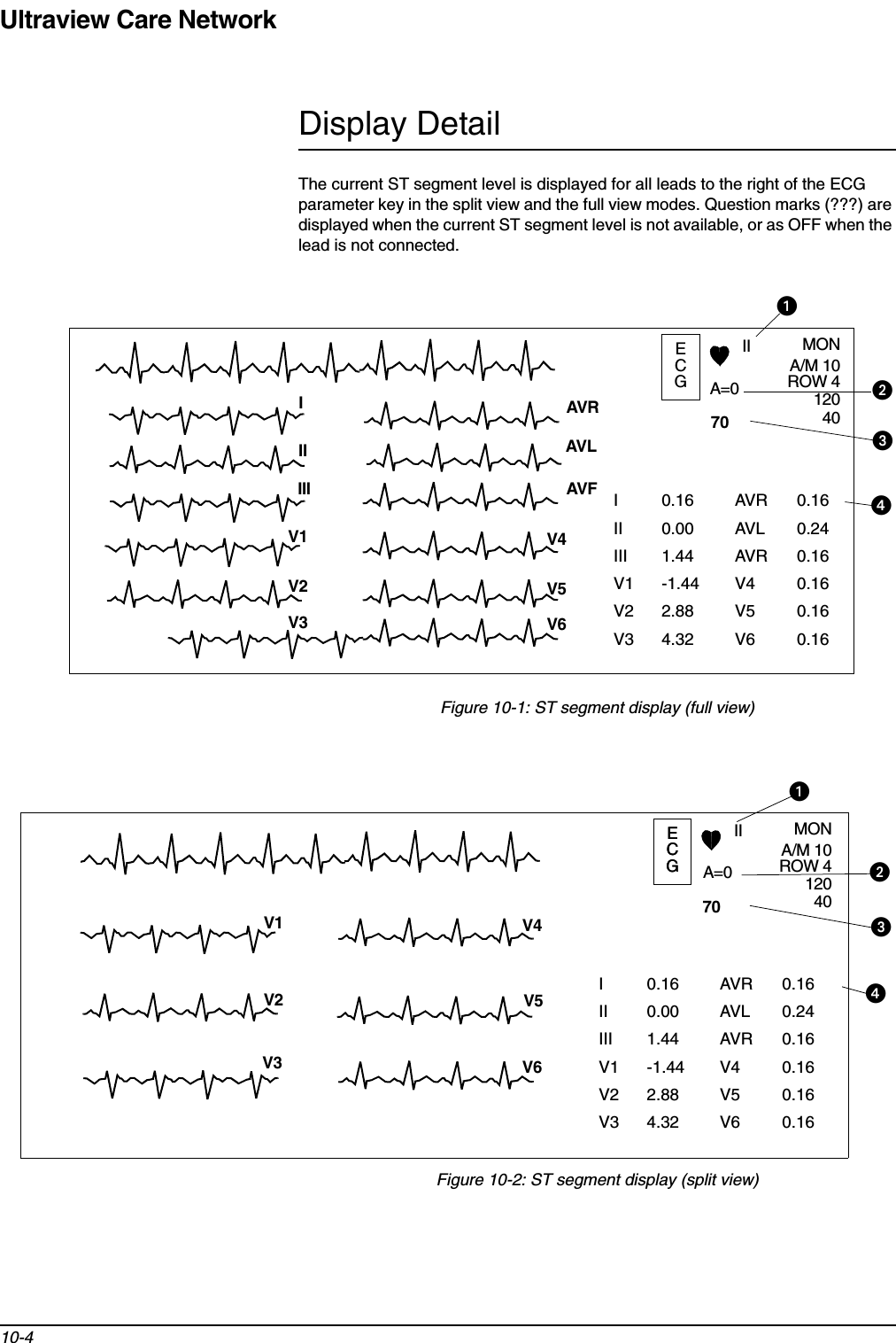 Ultraview Care Network10-4Display DetailThe current ST segment level is displayed for all leads to the right of the ECG parameter key in the split view and the full view modes. Question marks (???) are displayed when the current ST segment level is not available, or as OFF when the lead is not connected.Figure 10-1: ST segment display (full view)Figure 10-2: ST segment display (split view)I 0.16 AVR 0.16II 0.00 AVL 0.24III 1.44 AVR 0.16V1 -1.44 V4 0.16V2 2.88 V5 0.16V3 4.32 V6 0.16ᕡᕤECGII MONA=0A/M 10ROW 41204070AVRAVLAVFV4V5V6V1V2V3IIIIIIᕢᕣECGII MONA=0A/M 10ROW 41204070V4V6V1V2V3V5ᕡᕢᕣᕤECGI 0.16 AVR 0.16II 0.00 AVL 0.24III 1.44 AVR 0.16V1 -1.44 V4 0.16V2 2.88 V5 0.16V3 4.32 V6 0.16