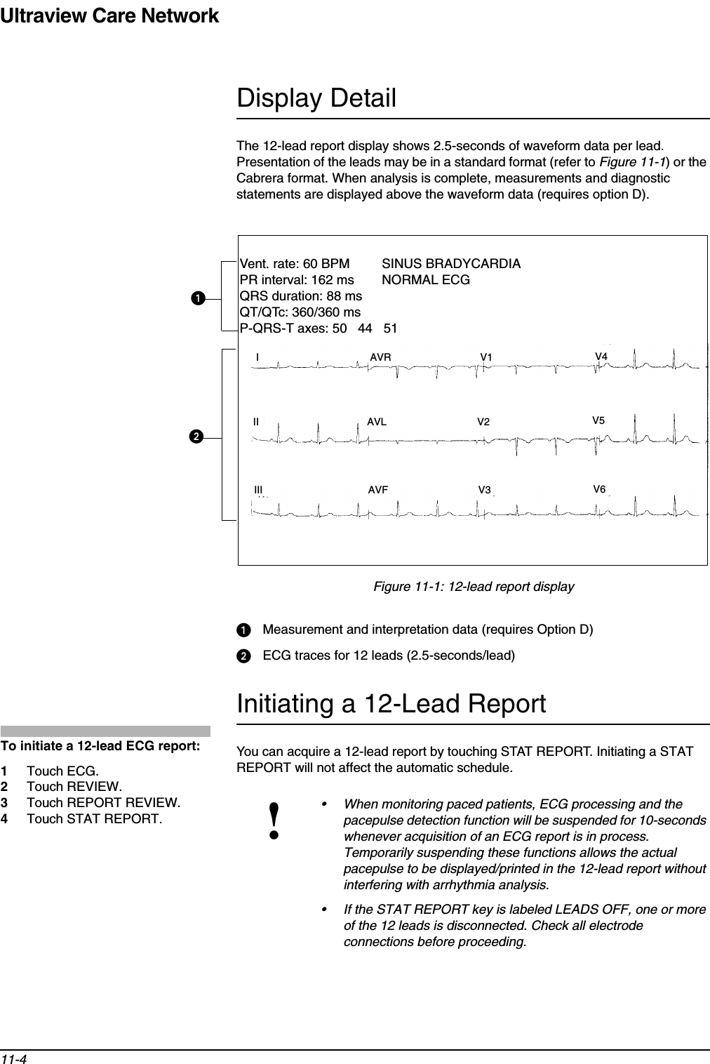 Ultraview Care Network11-4Display DetailThe 12-lead report display shows 2.5-seconds of waveform data per lead. Presentation of the leads may be in a standard format (refer to Figure 11-1) or the Cabrera format. When analysis is complete, measurements and diagnostic statements are displayed above the waveform data (requires option D).Figure 11-1: 12-lead report displayᕡMeasurement and interpretation data (requires Option D)ᕢECG traces for 12 leads (2.5-seconds/lead)Initiating a 12-Lead ReportYou can acquire a 12-lead report by touching STAT REPORT. Initiating a STAT REPORT will not affect the automatic schedule.!• When monitoring paced patients, ECG processing and the pacepulse detection function will be suspended for 10-seconds whenever acquisition of an ECG report is in process. Temporarily suspending these functions allows the actual pacepulse to be displayed/printed in the 12-lead report without interfering with arrhythmia analysis.• If the STAT REPORT key is labeled LEADS OFF, one or more of the 12 leads is disconnected. Check all electrode connections before proceeding.ᕡᕢVent. rate: 60 BPM SINUS BRADYCARDIAPR interval: 162 ms NORMAL ECGQRS duration: 88 msQT/QTc: 360/360 msP-QRS-T axes: 50   44   51I AVR V1 V4II AVL V2 V5III AVF V3 V6To initiate a 12-lead ECG report:1Touch ECG.2Touch REVIEW.3Touch REPORT REVIEW.4Touch STAT REPORT.