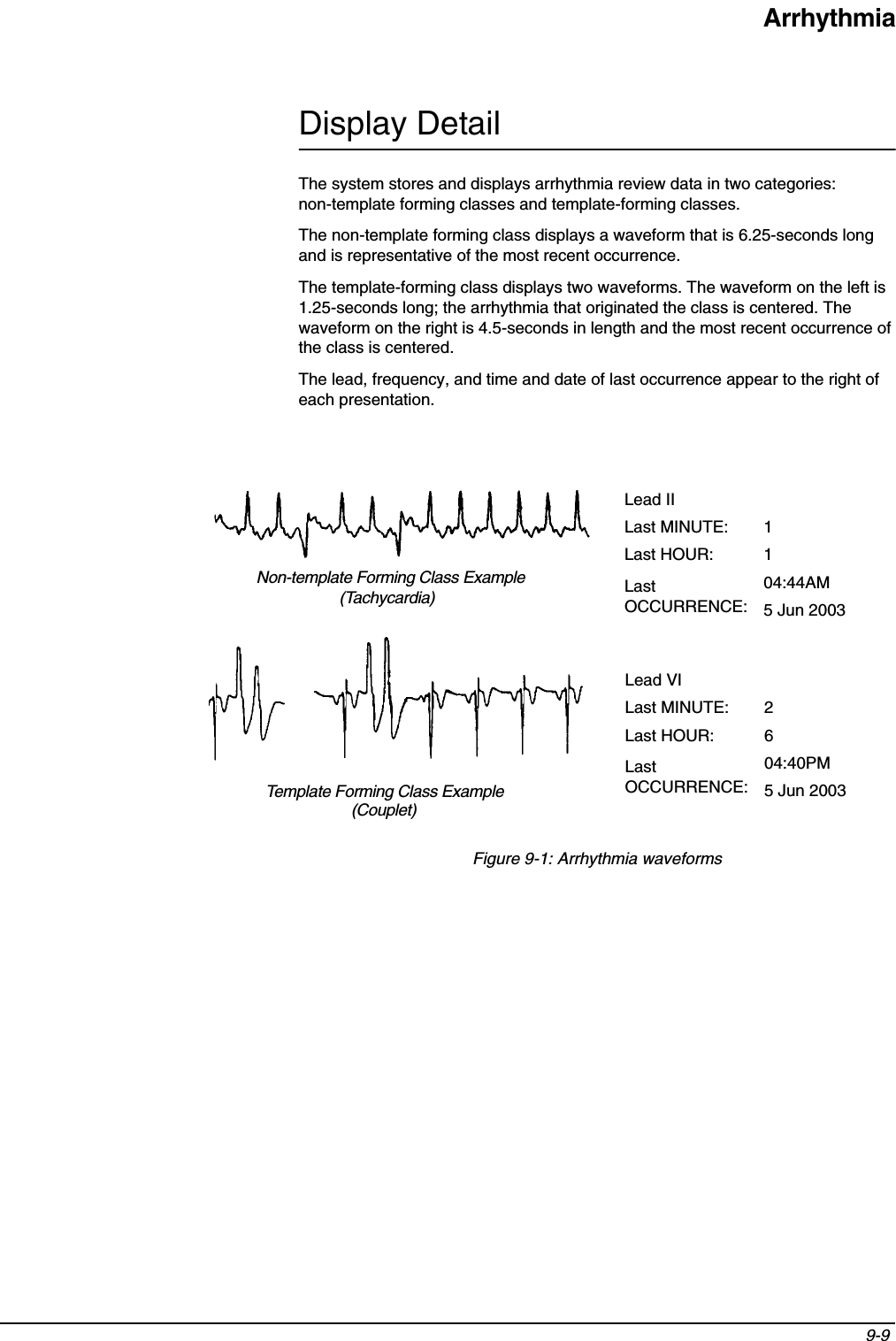 Arrhythmia9-9 Display DetailThe system stores and displays arrhythmia review data in two categories: non-template forming classes and template-forming classes.The non-template forming class displays a waveform that is 6.25-seconds long and is representative of the most recent occurrence.The template-forming class displays two waveforms. The waveform on the left is 1.25-seconds long; the arrhythmia that originated the class is centered. The waveform on the right is 4.5-seconds in length and the most recent occurrence of the class is centered.The lead, frequency, and time and date of last occurrence appear to the right of each presentation.Figure 9-1: Arrhythmia waveformsNon-template Forming Class ExampleTemplate Forming Class ExampleLead IILast MINUTE: 1Last HOUR: 1Last OCCURRENCE:04:44AM5 Jun 2003Lead VILast MINUTE: 2Last HOUR: 6Last OCCURRENCE:04:40PM5 Jun 2003(Tachycardia)(Couplet)
