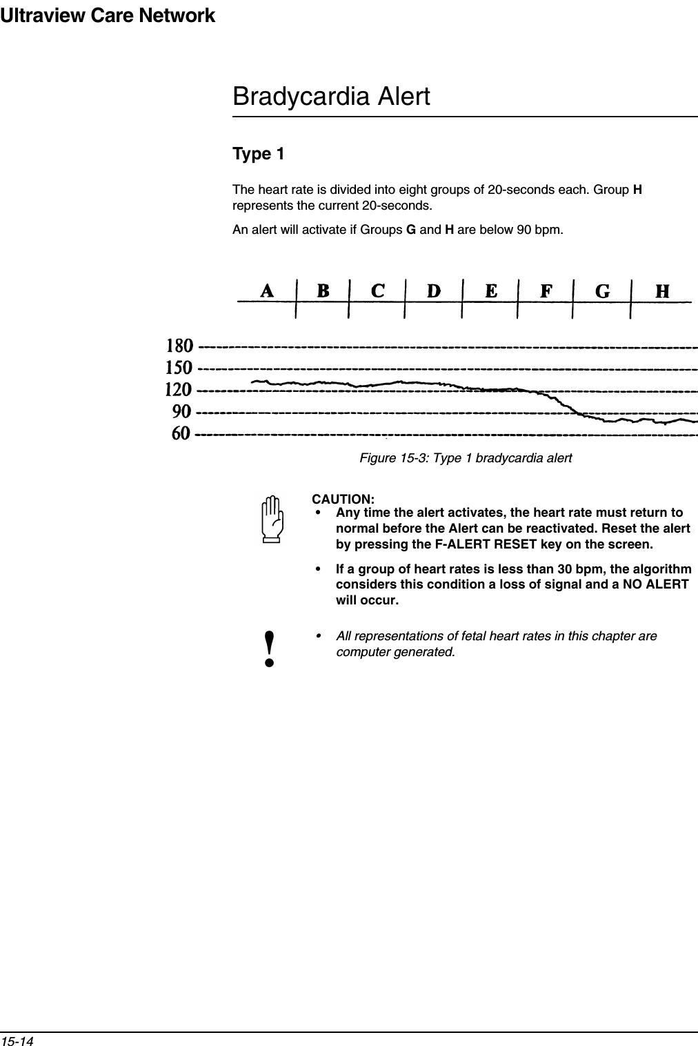 Ultraview Care Network15-14Bradycardia AlertType 1The heart rate is divided into eight groups of 20-seconds each. Group Hrepresents the current 20-seconds.An alert will activate if Groups Gand Hare below 90 bpm.Figure 15-3: Type 1 bradycardia alertCAUTION:• Any time the alert activates, the heart rate must return to normal before the Alert can be reactivated. Reset the alert by pressing the F-ALERT RESET key on the screen. • If a group of heart rates is less than 30 bpm, the algorithm considers this condition a loss of signal and a NO ALERT will occur.!• All representations of fetal heart rates in this chapter are computer generated.