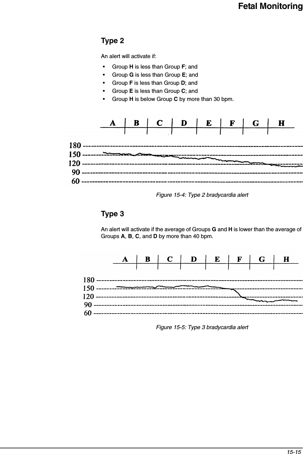 Fetal Monitoring15-15 Type 2An alert will activate if:•Group His less than Group F; and•Group Gis less than Group E; and•Group Fis less than Group D; and•Group Eis less than Group C; and•Group His below Group Cby more than 30 bpm.Figure 15-4: Type 2 bradycardia alertType 3An alert will activate if the average of Groups Gand His lower than the average of Groups A,B,C, and Dby more than 40 bpm.Figure 15-5: Type 3 bradycardia alert