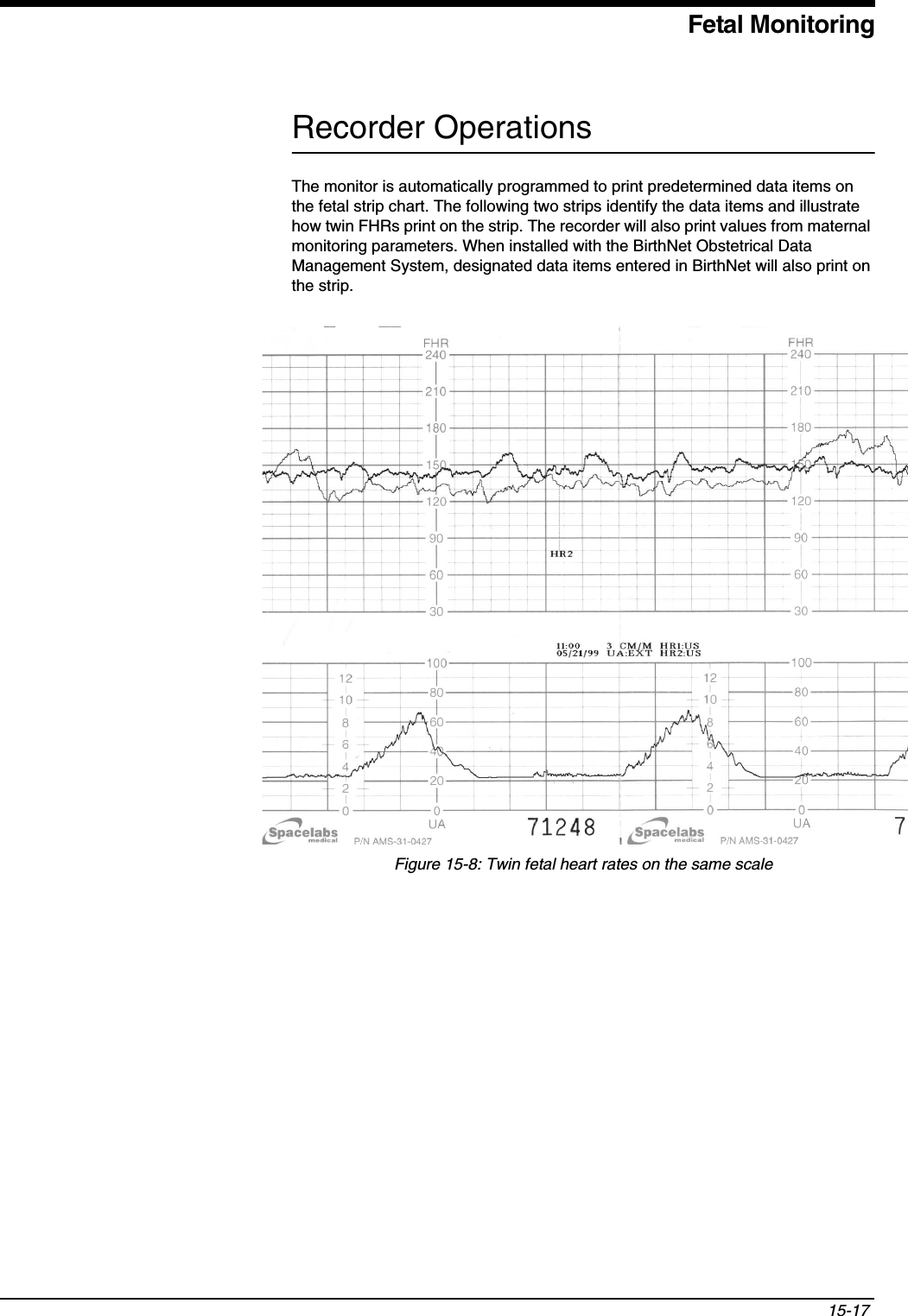 Fetal Monitoring15-17 Recorder OperationsThe monitor is automatically programmed to print predetermined data items on the fetal strip chart. The following two strips identify the data items and illustrate how twin FHRs print on the strip. The recorder will also print values from maternal monitoring parameters. When installed with the BirthNet Obstetrical Data Management System, designated data items entered in BirthNet will also print on the strip.Figure 15-8: Twin fetal heart rates on the same scale