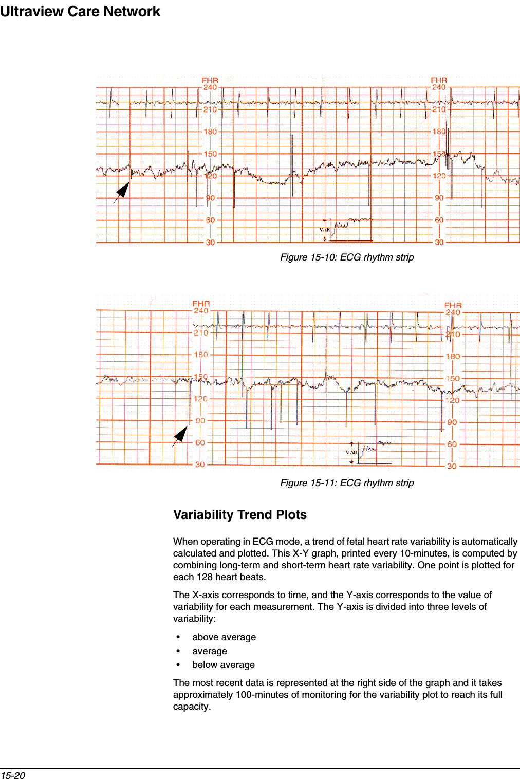 Ultraview Care Network15-20Figure 15-10: ECG rhythm stripFigure 15-11: ECG rhythm stripVariability Trend PlotsWhen operating in ECG mode, a trend of fetal heart rate variability is automatically calculated and plotted. This X-Y graph, printed every 10-minutes, is computed by combining long-term and short-term heart rate variability. One point is plotted for each 128 heart beats.The X-axis corresponds to time, and the Y-axis corresponds to the value of variability for each measurement. The Y-axis is divided into three levels of variability:• above average•average• below averageThe most recent data is represented at the right side of the graph and it takes approximately 100-minutes of monitoring for the variability plot to reach its full capacity.