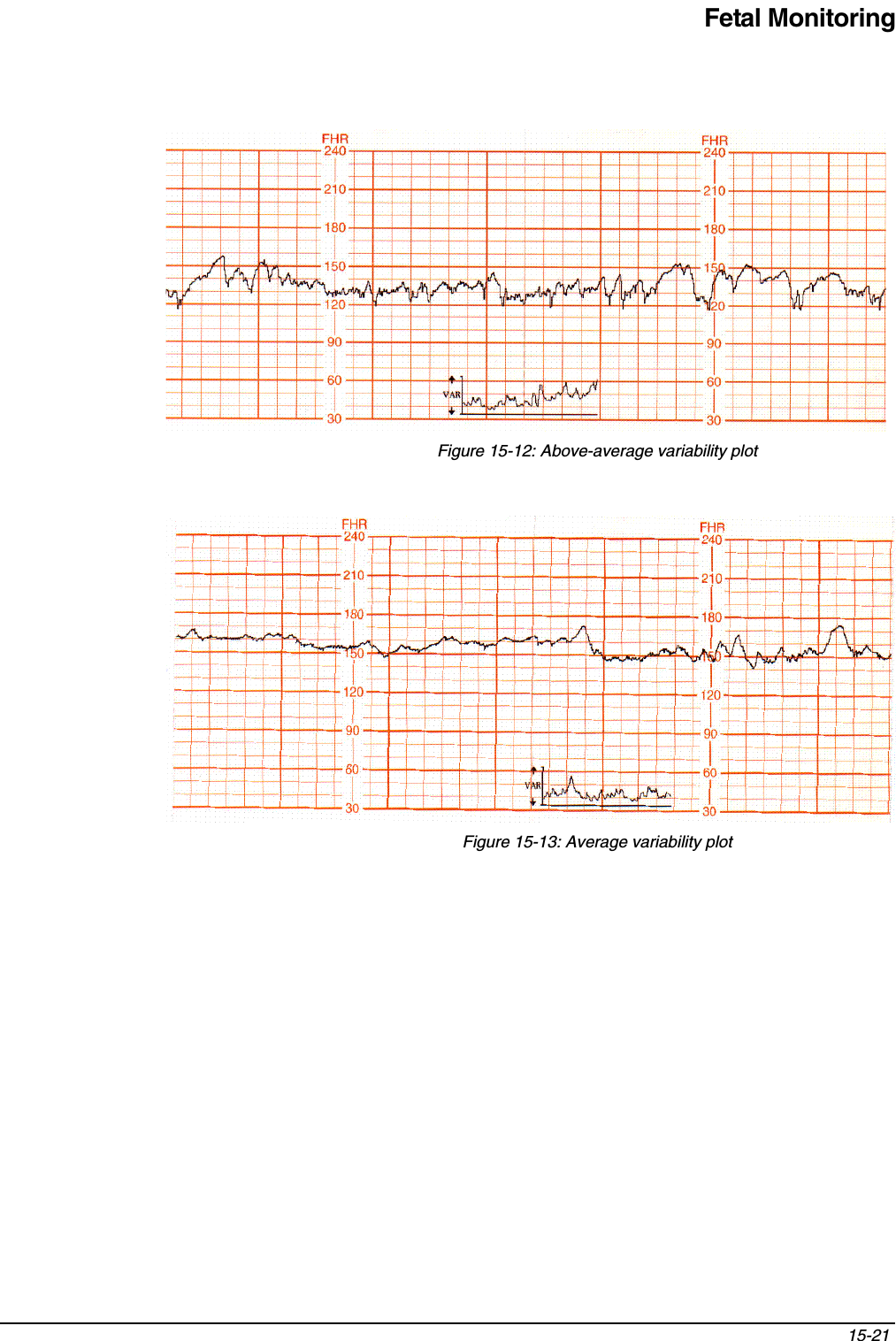 Fetal Monitoring15-21 Figure 15-12: Above-average variability plotFigure 15-13: Average variability plot