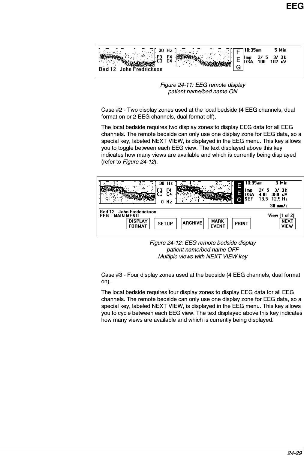 EEG24-29 Figure 24-11: EEG remote displaypatient name/bed name ONCase #2 - Two display zones used at the local bedside (4 EEG channels, dual format on or 2 EEG channels, dual format off).The local bedside requires two display zones to display EEG data for all EEG channels. The remote bedside can only use one display zone for EEG data, so a special key, labeled NEXT VIEW, is displayed in the EEG menu. This key allows you to toggle between each EEG view. The text displayed above this key indicates how many views are available and which is currently being displayed (refer to Figure 24-12).Figure 24-12: EEG remote bedside displaypatient name/bed name OFFMultiple views with NEXT VIEW keyCase #3 - Four display zones used at the bedside (4 EEG channels, dual format on).The local bedside requires four display zones to display EEG data for all EEG channels. The remote bedside can only use one display zone for EEG data, so a special key, labeled NEXT VIEW, is displayed in the EEG menu. This key allows you to cycle between each EEG view. The text displayed above this key indicates how many views are available and which is currently being displayed. ARCHIVE