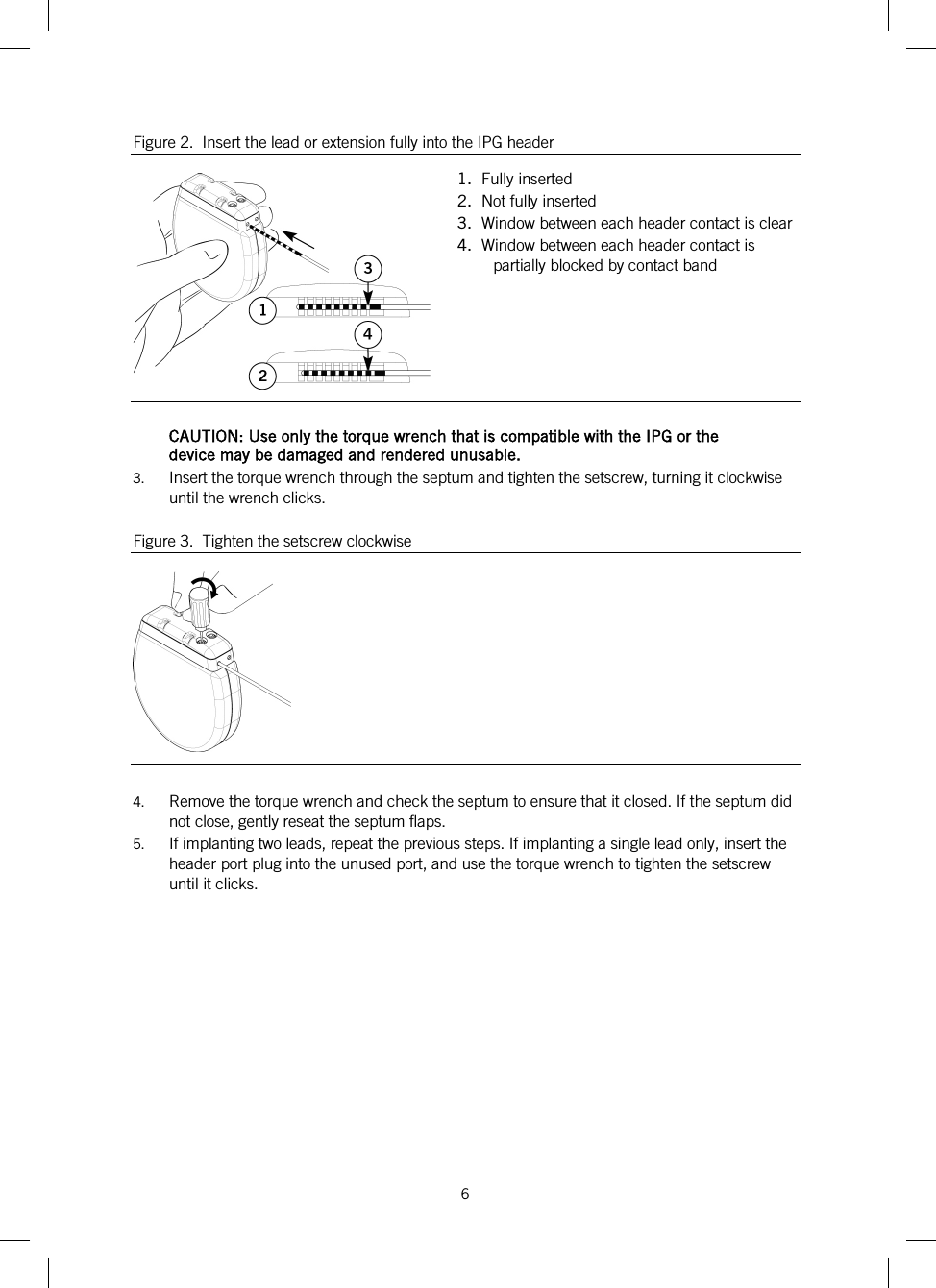  6   Figure 2.  Insert the lead or extension fully into the IPG header  1.  Fully inserted 2.  Not fully inserted 3.  Window between each header contact is clear 4.  Window between each header contact is partially blocked by contact band  CAUTION: Use only the torque wrench that is compatible with the IPG or the device may be damaged and rendered unusable. 3. Insert the torque wrench through the septum and tighten the setscrew, turning it clockwise until the wrench clicks. Figure 3.  Tighten the setscrew clockwise   4. Remove the torque wrench and check the septum to ensure that it closed. If the septum did not close, gently reseat the septum flaps. 5. If implanting two leads, repeat the previous steps. If implanting a single lead only, insert the header port plug into the unused port, and use the torque wrench to tighten the setscrew until it clicks. 