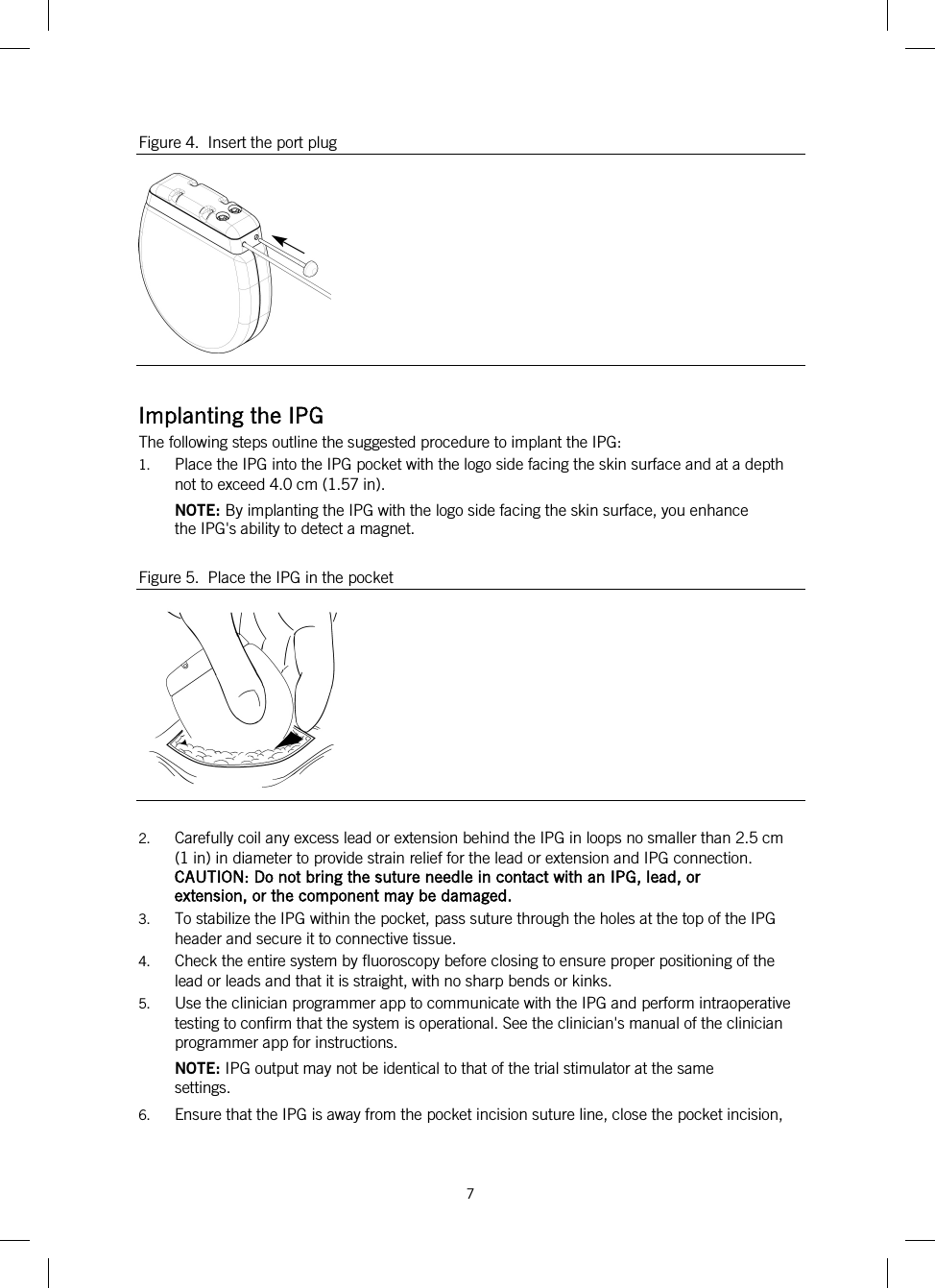  7   Figure 4.  Insert the port plug   Implanting the IPG The following steps outline the suggested procedure to implant the IPG: 1. Place the IPG into the IPG pocket with the logo side facing the skin surface and at a depth not to exceed 4.0 cm (1.57 in). NOTE: By implanting the IPG with the logo side facing the skin surface, you enhance the IPG&apos;s ability to detect a magnet. Figure 5.  Place the IPG in the pocket   2. Carefully coil any excess lead or extension behind the IPG in loops no smaller than 2.5 cm (1 in) in diameter to provide strain relief for the lead or extension and IPG connection. CAUTION: Do not bring the suture needle in contact with an IPG, lead, or extension, or the component may be damaged. 3. To stabilize the IPG within the pocket, pass suture through the holes at the top of the IPG header and secure it to connective tissue. 4. Check the entire system by fluoroscopy before closing to ensure proper positioning of the lead or leads and that it is straight, with no sharp bends or kinks. 5. Use the clinician programmer app to communicate with the IPG and perform intraoperative testing to confirm that the system is operational. See the clinician&apos;s manual of the clinician programmer app for instructions. NOTE: IPG output may not be identical to that of the trial stimulator at the same settings. 6. Ensure that the IPG is away from the pocket incision suture line, close the pocket incision, 