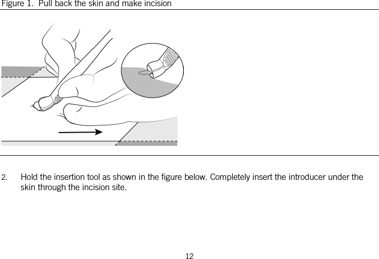  Figure 1.  Pull back the skin and make incision   2. Hold the insertion tool as shown in the figure below. Completely insert the introducer under the skin through the incision site. 12   