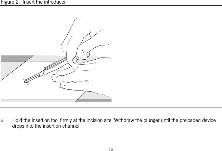  Figure 2.  Insert the introducer   3. Hold the insertion tool firmly at the incision site. Withdraw the plunger until the preloaded device drops into the insertion channel. 13   