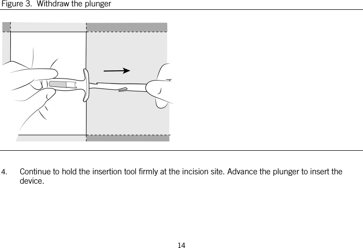  Figure 3.  Withdraw the plunger   4. Continue to hold the insertion tool firmly at the incision site. Advance the plunger to insert the device. 14   