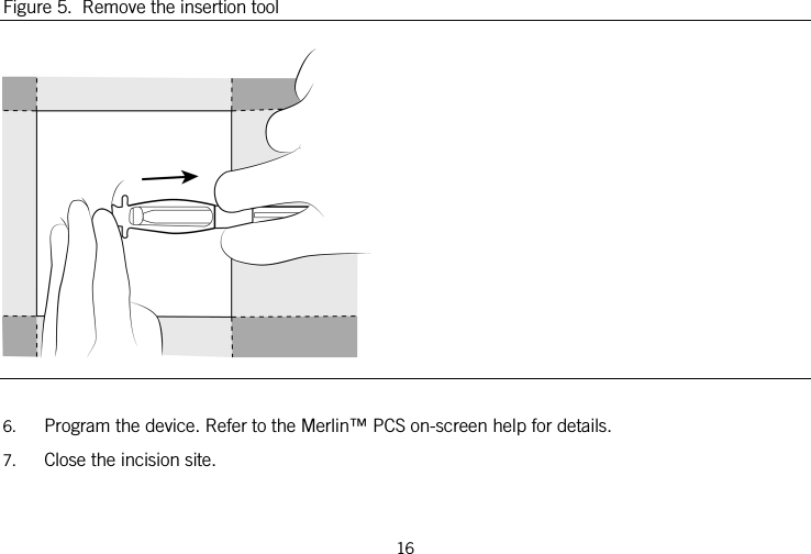  Figure 5.  Remove the insertion tool   6. Program the device. Refer to the Merlin™ PCS on-screen help for details. 7. Close the incision site. 16   