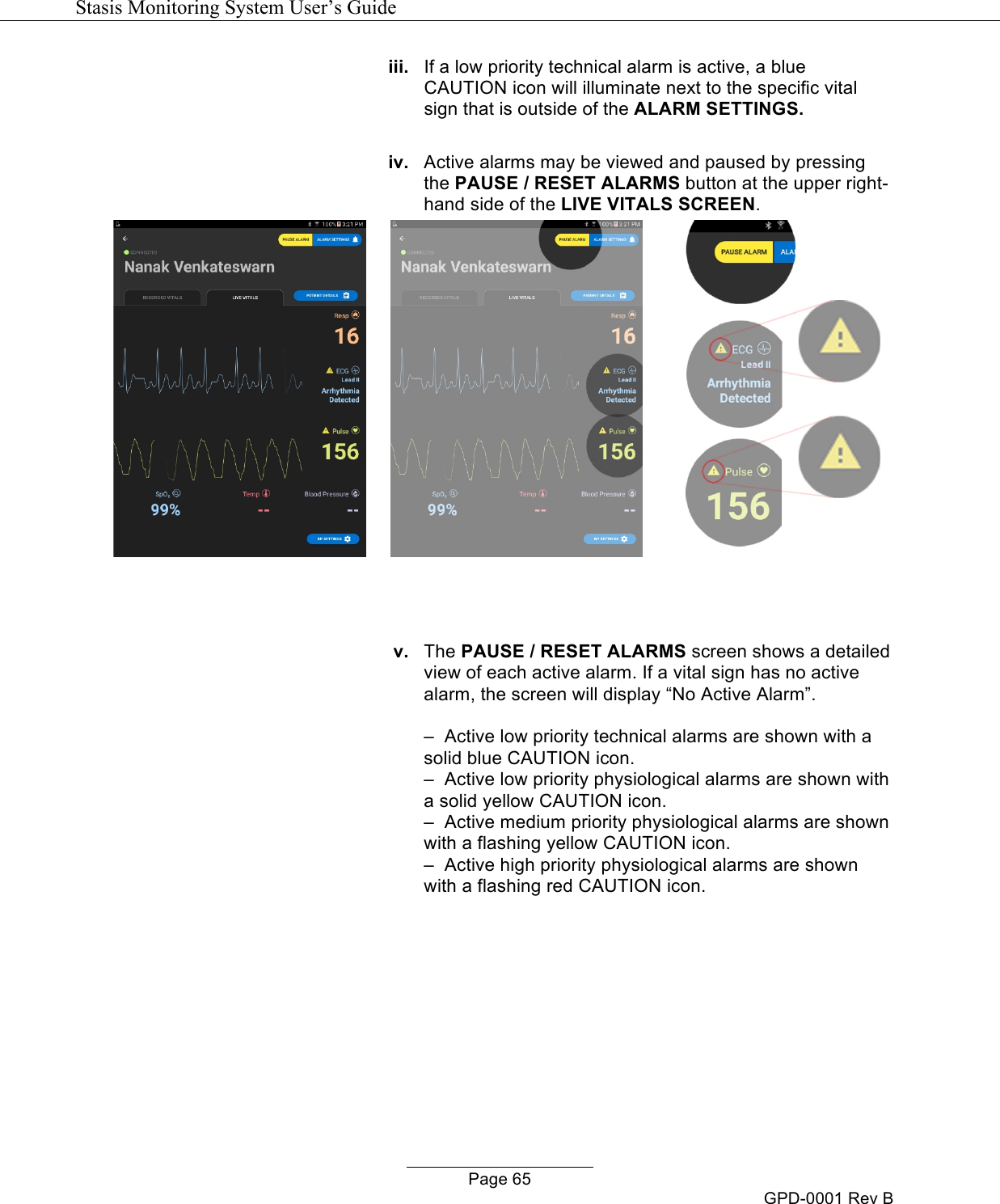   Stasis Monitoring System User&rsquo;s Guide   Page 65 GPD-0001 Rev B iii. If a low priority technical alarm is active, a blue CAUTION icon will illuminate next to the specific vital sign that is outside of the ALARM SETTINGS.  iv. Active alarms may be viewed and paused by pressing the PAUSE / RESET ALARMS button at the upper right-hand side of the LIVE VITALS SCREEN.     v. The PAUSE / RESET ALARMS screen shows a detailed view of each active alarm. If a vital sign has no active alarm, the screen will display &ldquo;No Active Alarm&rdquo;.  &ndash;  Active low priority technical alarms are shown with a solid blue CAUTION icon.  &ndash;  Active low priority physiological alarms are shown with a solid yellow CAUTION icon.  &ndash;  Active medium priority physiological alarms are shown with a flashing yellow CAUTION icon.  &ndash;  Active high priority physiological alarms are shown with a flashing red CAUTION icon. 