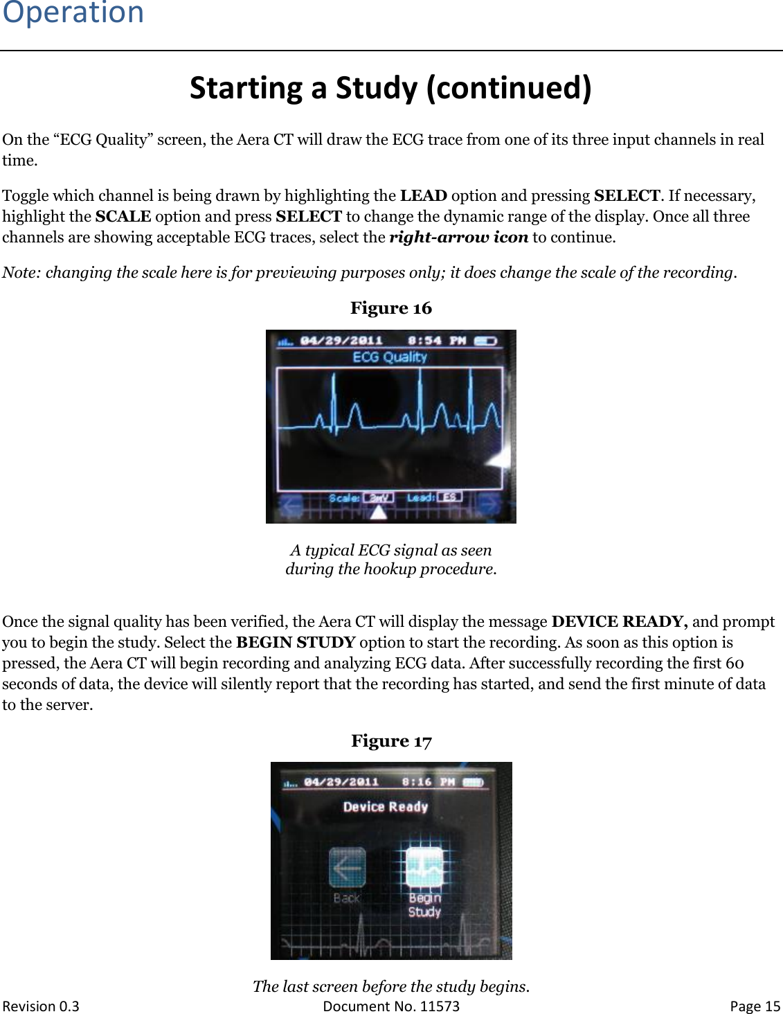  Revision 0.3 Document No. 11573 Page 15  Operation Starting a Study (continued) On the “ECG Quality” screen, the Aera CT will draw the ECG trace from one of its three input channels in real time.  Toggle which channel is being drawn by highlighting the LEAD option and pressing SELECT. If necessary, highlight the SCALE option and press SELECT to change the dynamic range of the display. Once all three channels are showing acceptable ECG traces, select the right-arrow icon to continue.  Note: changing the scale here is for previewing purposes only; it does change the scale of the recording. Figure 16   A typical ECG signal as seen  during the hookup procedure.  Once the signal quality has been verified, the Aera CT will display the message DEVICE READY, and prompt you to begin the study. Select the BEGIN STUDY option to start the recording. As soon as this option is pressed, the Aera CT will begin recording and analyzing ECG data. After successfully recording the first 60 seconds of data, the device will silently report that the recording has started, and send the first minute of data to the server. Figure 17   The last screen before the study begins. 