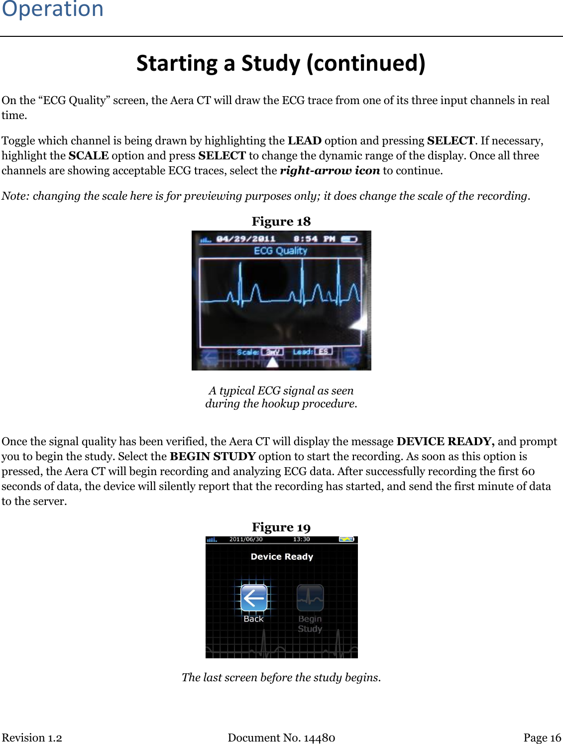 Revision 1.2 Document No. 14480 Page 16  Operation Starting a Study (continued) On the “ECG Quality” screen, the Aera CT will draw the ECG trace from one of its three input channels in real time.  Toggle which channel is being drawn by highlighting the LEAD option and pressing SELECT. If necessary, highlight the SCALE option and press SELECT to change the dynamic range of the display. Once all three channels are showing acceptable ECG traces, select the right-arrow icon to continue.  Note: changing the scale here is for previewing purposes only; it does change the scale of the recording. Figure 18   A typical ECG signal as seen  during the hookup procedure.  Once the signal quality has been verified, the Aera CT will display the message DEVICE READY, and prompt you to begin the study. Select the BEGIN STUDY option to start the recording. As soon as this option is pressed, the Aera CT will begin recording and analyzing ECG data. After successfully recording the first 60 seconds of data, the device will silently report that the recording has started, and send the first minute of data to the server. Figure 19   The last screen before the study begins.  