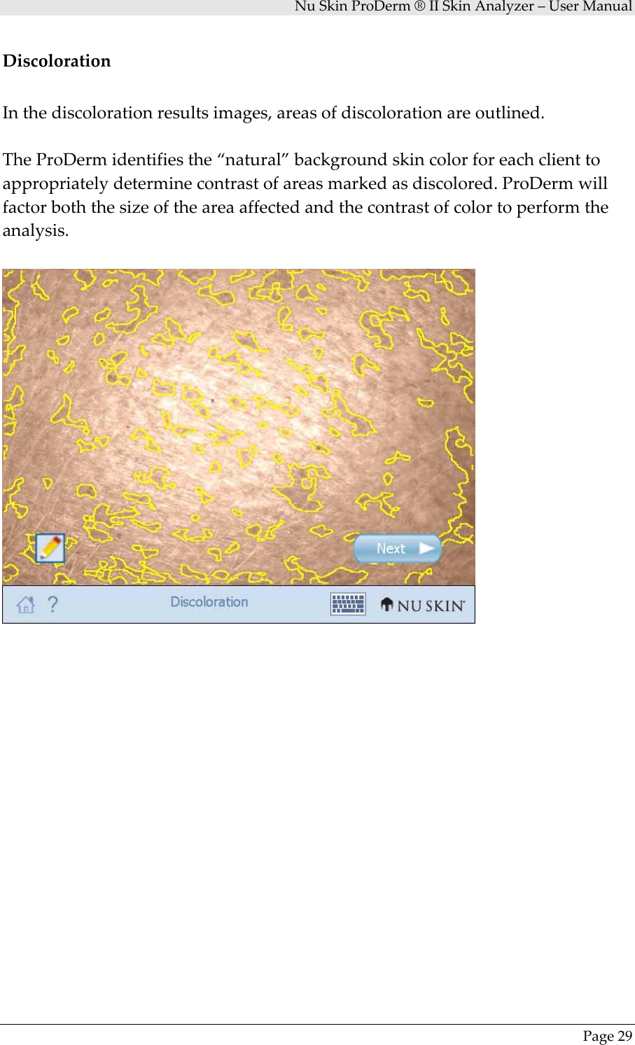 NuSkinProDerm®IISkinAnalyzer–UserManualPage29DiscolorationInthediscolorationresultsimages,areasofdiscolorationareoutlined.TheProDermidentifiesthe“natural”backgroundskincolorforeachclienttoappropriatelydeterminecontrastofareasmarkedasdiscolored.ProDermwillfactorboththesizeoftheareaaffectedandthecontrastofcolortoperformtheanalysis.