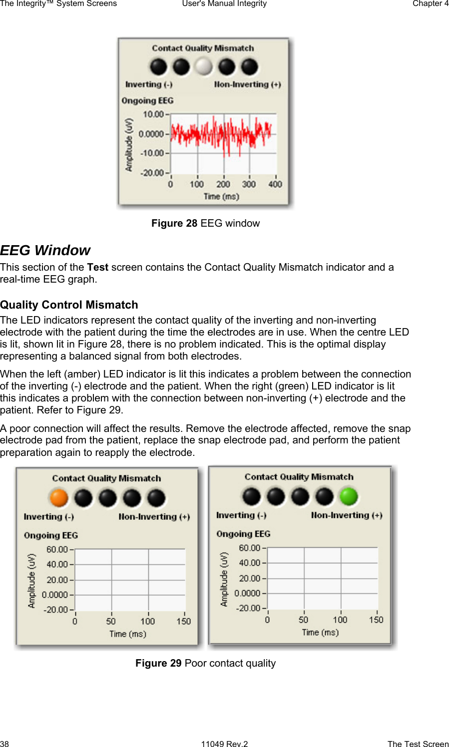 The Integrity™ System Screens  User&apos;s Manual Integrity  Chapter 4  38  11049 Rev.2  The Test Screen  Figure 28 EEG window EEG Window This section of the Test screen contains the Contact Quality Mismatch indicator and a real-time EEG graph. Quality Control Mismatch  The LED indicators represent the contact quality of the inverting and non-inverting electrode with the patient during the time the electrodes are in use. When the centre LED is lit, shown lit in Figure 28, there is no problem indicated. This is the optimal display representing a balanced signal from both electrodes.  When the left (amber) LED indicator is lit this indicates a problem between the connection of the inverting (-) electrode and the patient. When the right (green) LED indicator is lit this indicates a problem with the connection between non-inverting (+) electrode and the patient. Refer to Figure 29. A poor connection will affect the results. Remove the electrode affected, remove the snap electrode pad from the patient, replace the snap electrode pad, and perform the patient preparation again to reapply the electrode.    Figure 29 Poor contact quality 