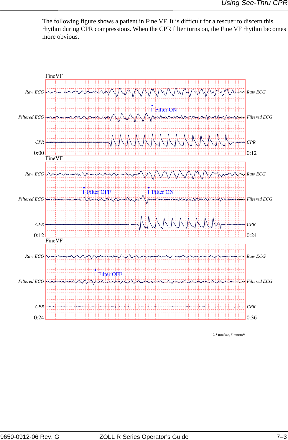 Using See-Thru CPR9650-0912-06 Rev. G ZOLL R Series Operator’s Guide 7–3The following figure shows a patient in Fine VF. It is difficult for a rescuer to discern this rhythm during CPR compressions. When the CPR filter turns on, the Fine VF rhythm becomes more obvious.FineVF0:00 0:12Raw ECG Raw ECGFiltered ECG Filtered ECGCPR CPR|  Filter ON•FineVF0:12 0:24Raw ECG Raw ECGFiltered ECG Filtered ECGCPR CPR|  Filter OFF•|  Filter ON•FineVF0:24 0:36Raw ECG Raw ECGFiltered ECG Filtered ECGCPR CPR|  Filter OFF•12.5 mm/sec, 5 mm/mV