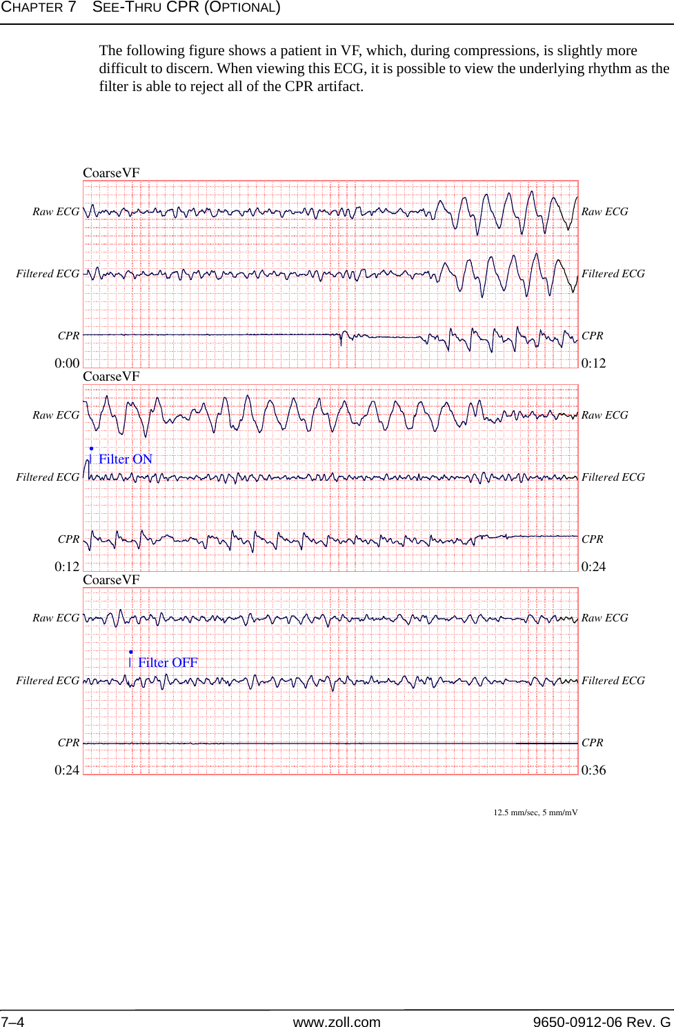 CHAPTER 7SEE-THRU CPR (OPTIONAL)7–4 www.zoll.com 9650-0912-06 Rev. GThe following figure shows a patient in VF, which, during compressions, is slightly more difficult to discern. When viewing this ECG, it is possible to view the underlying rhythm as the filter is able to reject all of the CPR artifact.CoarseVF0:00 0:12Raw ECG Raw ECGFiltered ECG Filtered ECGCPR CPRCoarseVF0:12 0:24Raw ECG Raw ECGFiltered ECG Filtered ECGCPR CPR|  Filter ON•CoarseVF0:24 0:36Raw ECG Raw ECGFiltered ECG Filtered ECGCPR CPR|  Filter OFF•12.5 mm/sec, 5 mm/mV