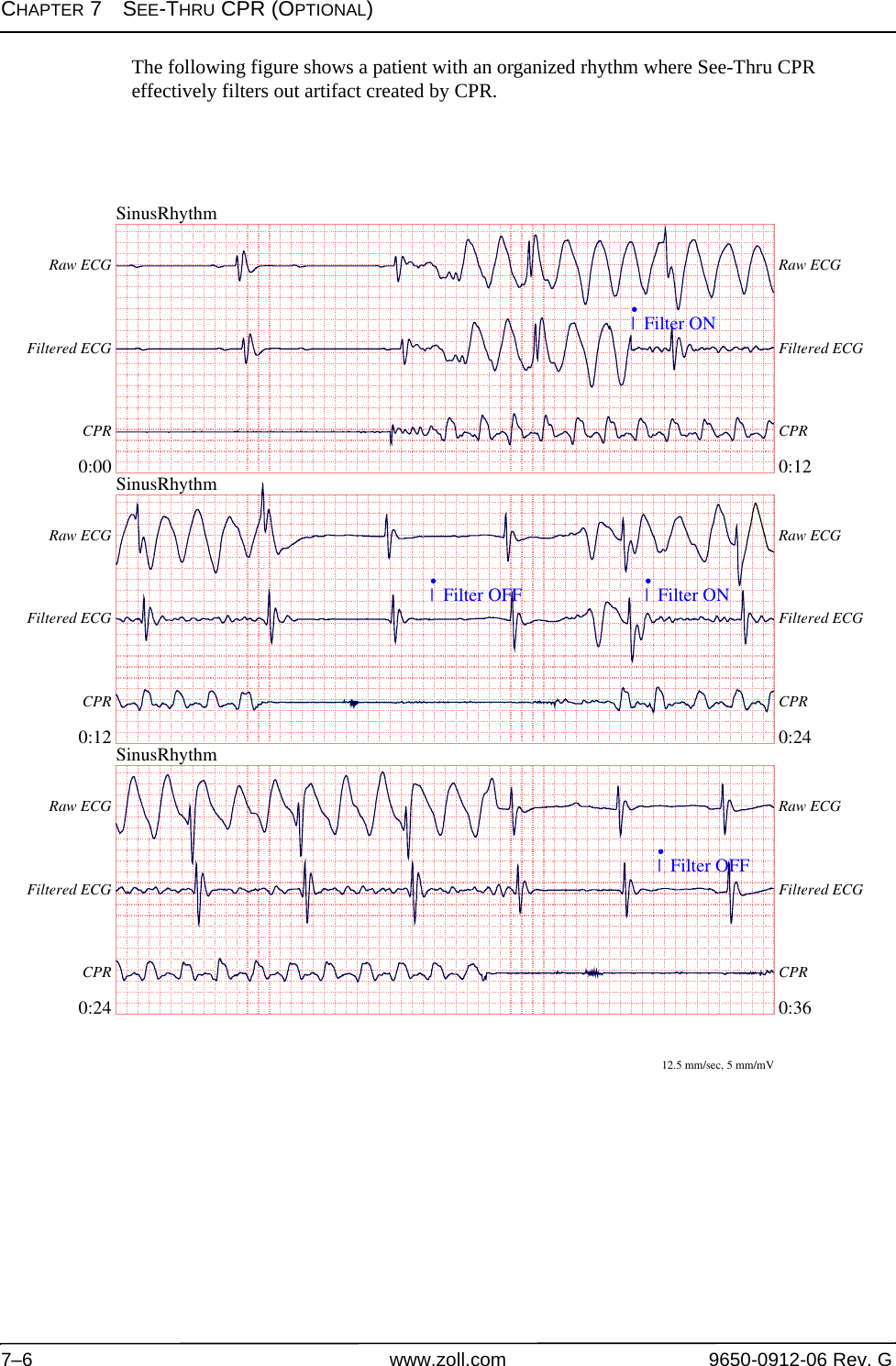 CHAPTER 7SEE-THRU CPR (OPTIONAL)7–6 www.zoll.com 9650-0912-06 Rev. GThe following figure shows a patient with an organized rhythm where See-Thru CPR effectively filters out artifact created by CPR.SinusRhythm0:00 0:12Raw ECG Raw ECGFiltered ECG Filtered ECGCPR CPR|  Filter ON•SinusRhythm0:12 0:24Raw ECG Raw ECGFiltered ECG Filtered ECGCPR CPR|  Filter OFF•|  Filter ON•SinusRhythm0:24 0:36Raw ECG Raw ECGFiltered ECG Filtered ECGCPR CPR|  Filter OFF•12.5 mm/sec, 5 mm/mV