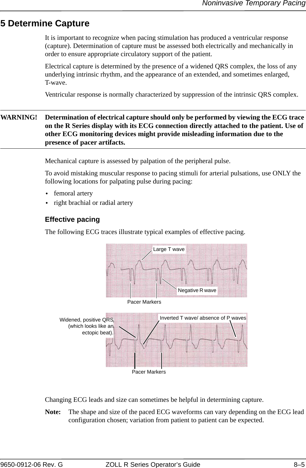 Noninvasive Temporary Pacing9650-0912-06 Rev. G ZOLL R Series Operator’s Guide 8–55 Determine CaptureIt is important to recognize when pacing stimulation has produced a ventricular response (capture). Determination of capture must be assessed both electrically and mechanically in order to ensure appropriate circulatory support of the patient. Electrical capture is determined by the presence of a widened QRS complex, the loss of any underlying intrinsic rhythm, and the appearance of an extended, and sometimes enlarged, T-wave.Ventricular response is normally characterized by suppression of the intrinsic QRS complex.WARNING! Determination of electrical capture should only be performed by viewing the ECG trace on the R Series display with its ECG connection directly attached to the patient. Use of other ECG monitoring devices might provide misleading information due to the presence of pacer artifacts.Mechanical capture is assessed by palpation of the peripheral pulse.To avoid mistaking muscular response to pacing stimuli for arterial pulsations, use ONLY the following locations for palpating pulse during pacing:•femoral artery•right brachial or radial arteryEffective pacingThe following ECG traces illustrate typical examples of effective pacing.Changing ECG leads and size can sometimes be helpful in determining capture. Note: The shape and size of the paced ECG waveforms can vary depending on the ECG lead configuration chosen; variation from patient to patient can be expected.Large T waveNegative R wave Inverted T wave/ absence of P wavesPacer MarkersPacer MarkersWidened, positive QRS(which looks like anectopic beat).,